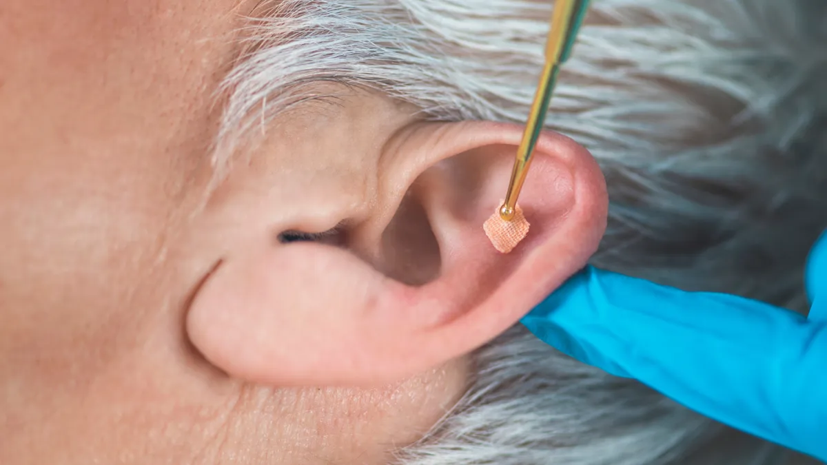 Aplicación de balines de auriculoterapia en puntos de la oreja.