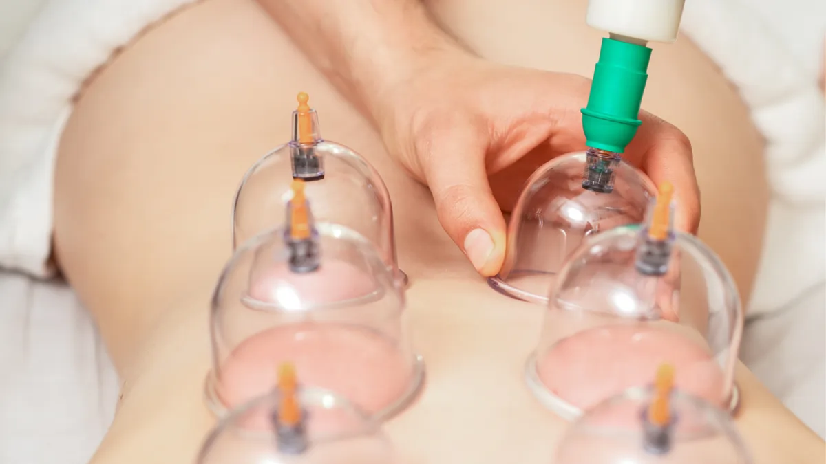 Tratamiento de cupping con ventosas para desintoxicación muscular.